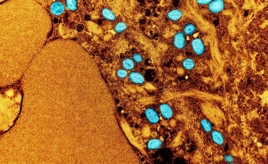 Mpox: saiba quais são os sintomas e formas de transmissão da doença